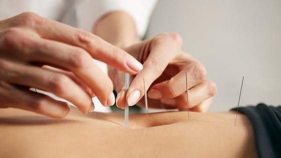 0Agulhas de acupuntura intradérmica de prata para aliviar a dor.